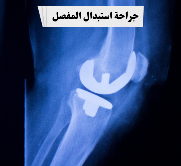 جراحة استبدال المفصل